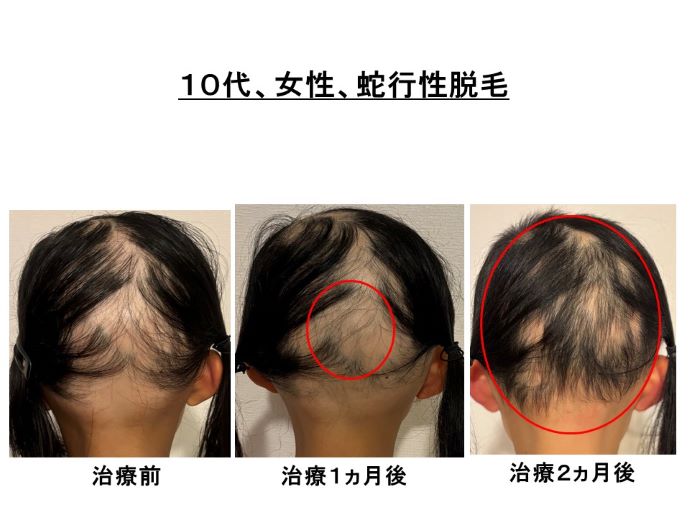 円形脱毛症　病院